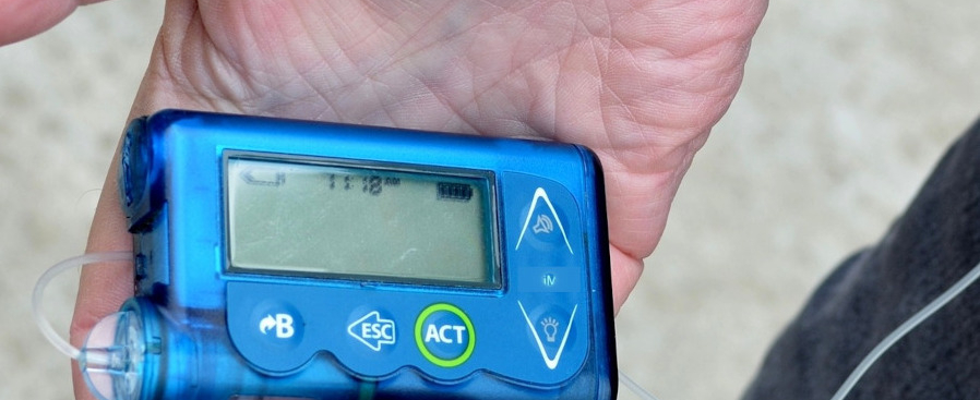 Aktywność fizyczna z pompą insulinową – jak to „ogarnąć”?